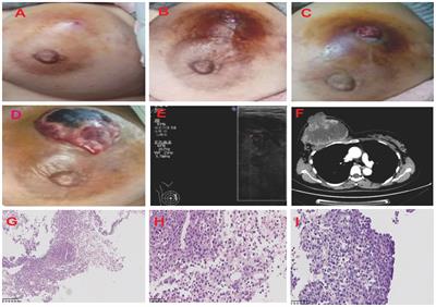 Case report: The first case of concurrent breast myeloid sarcoma and borderline phyllodes tumor with malignant features